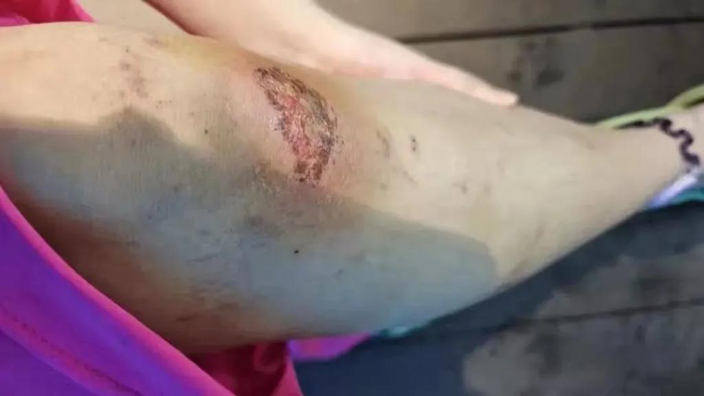 “美人鱼	”女孩溺水进了ICU	，危险的青春饭  第10张